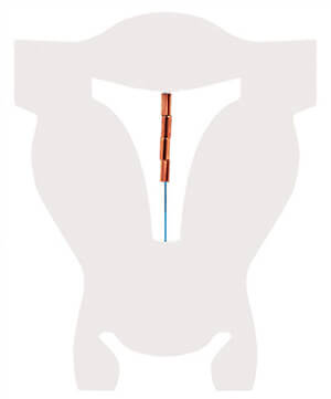 verhueten ohne hormone kupferkette gynefix